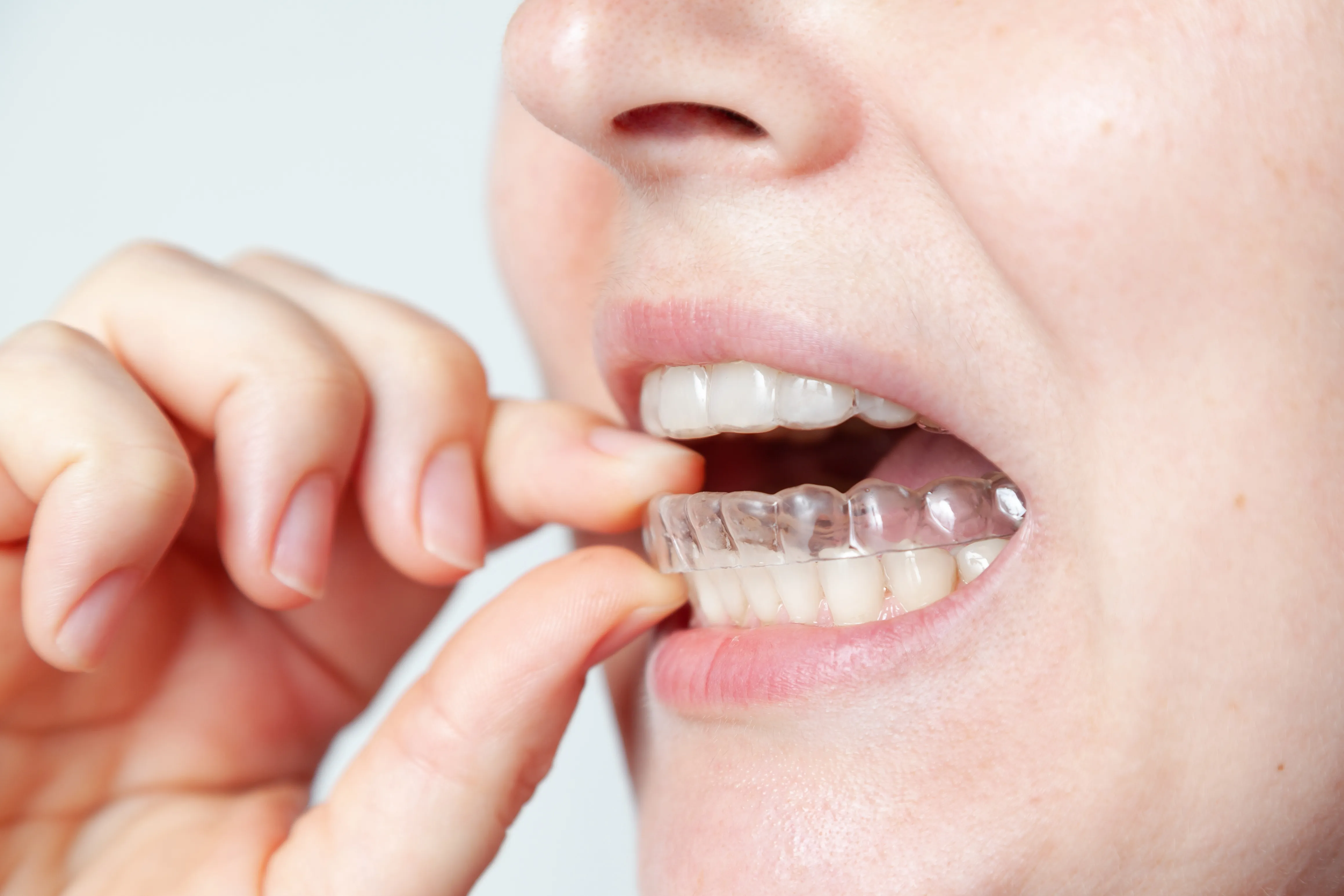 矯正中だと気づかれにくい